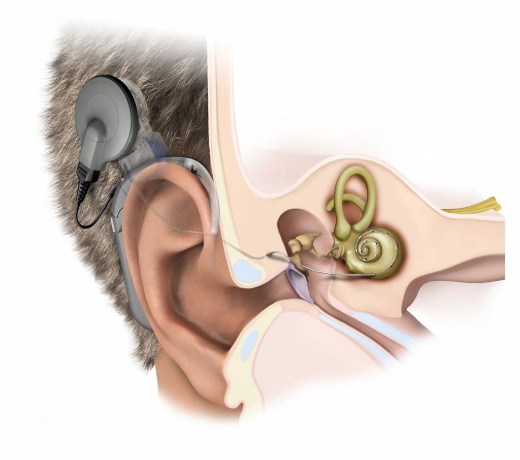 Hearing Institute Atlantic — Beyond Traditional Hearing Aids Cochlear Implants